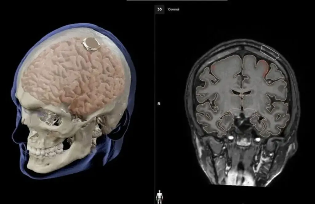 Illustration showing a human brain with an implanted Neuralink chip.